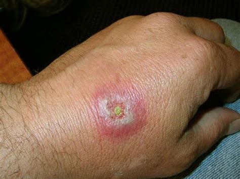 The brown recluse’s bite is usually painless and not felt by the bitten person. Symptoms of the bite vary but generally include the following: redness, swelling and a burning sensation developing around the bite within one hour. The red area may enlarge over the next eight hours, and the bite may blister to resemble a bad pimple. 
